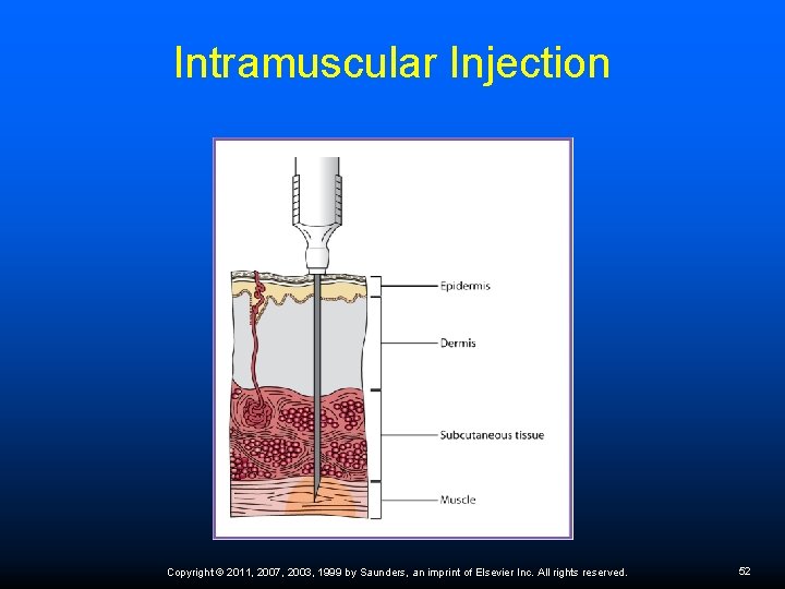 Intramuscular Injection Copyright © 2011, 2007, 2003, 1999 by Saunders, an imprint of Elsevier