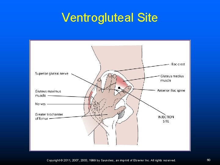 Ventrogluteal Site Copyright © 2011, 2007, 2003, 1999 by Saunders, an imprint of Elsevier