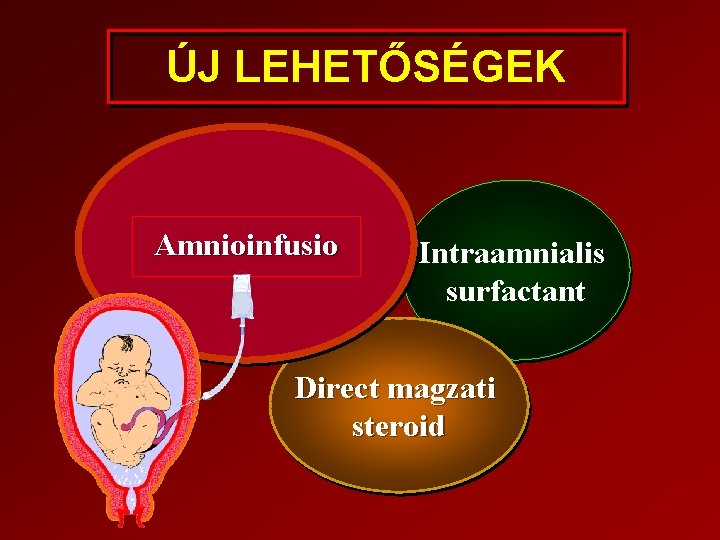 ÚJ LEHETŐSÉGEK Amnioinfusio Intraamnialis surfactant Direct magzati steroid 