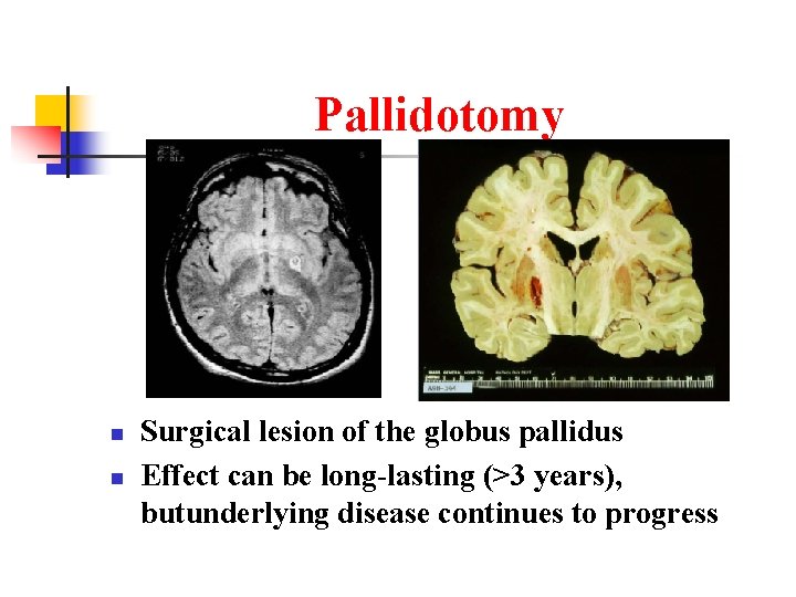 Pallidotomy n n Surgical lesion of the globus pallidus Effect can be long-lasting (>3