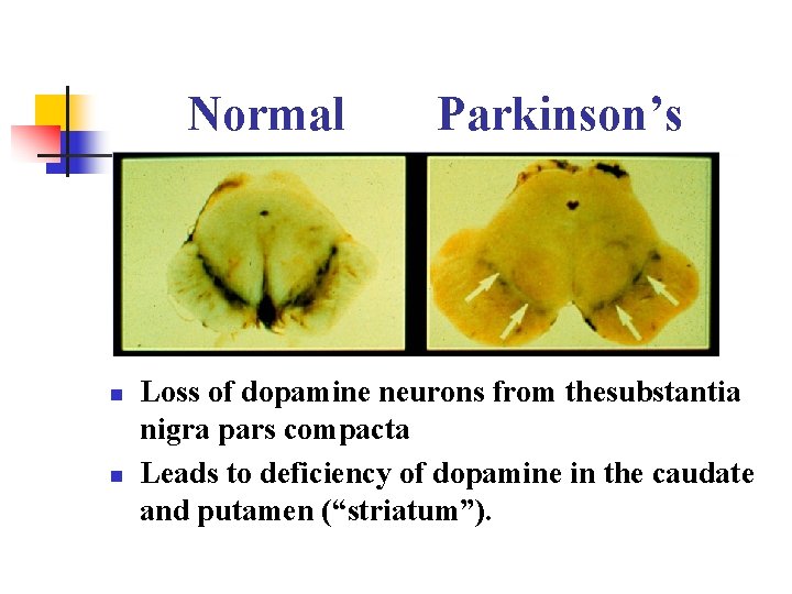 Normal n n Parkinson’s Loss of dopamine neurons from thesubstantia nigra pars compacta Leads