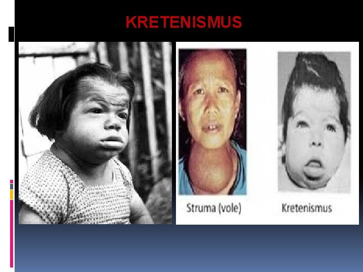 KRETENISMUS 