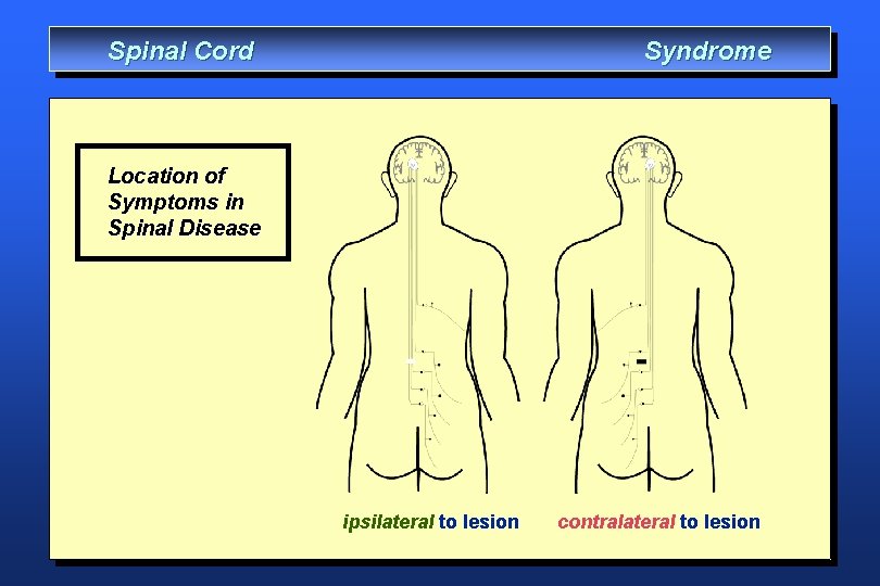 Spinal Cord Syndrome Location of Symptoms in Spinal Disease ipsilateral to lesion contralateral to