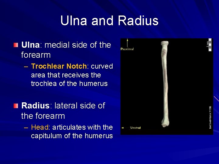 Ulna and Radius Ulna: medial side of the forearm – Trochlear Notch: curved area