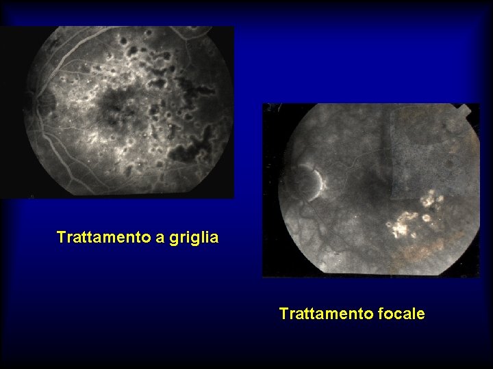 Trattamento a griglia Trattamento focale 