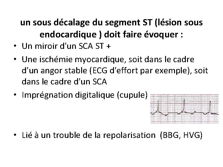 un sous décalage du segment ST (lésion sous endocardique ) doit faire évoquer :