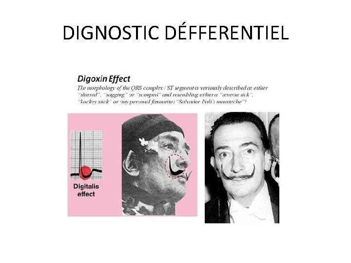 DIGNOSTIC DÉFFERENTIEL 