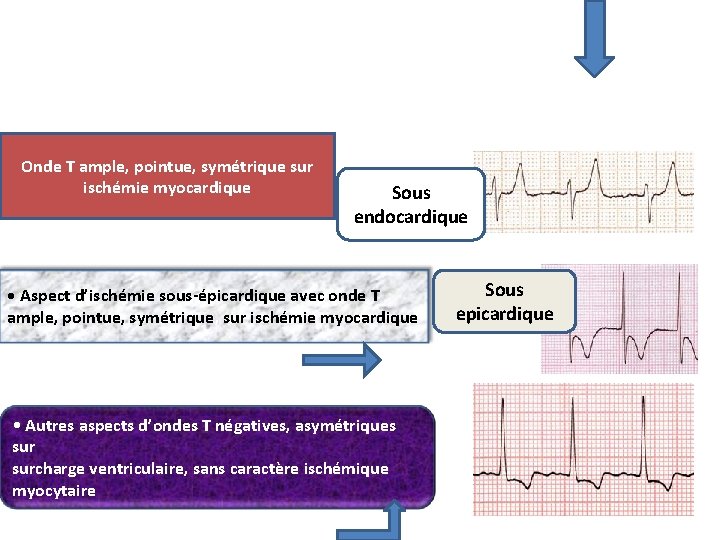 Onde T ample, pointue, symétrique sur ischémie myocardique Sous endocardique • Aspect d’ischémie sous-épicardique