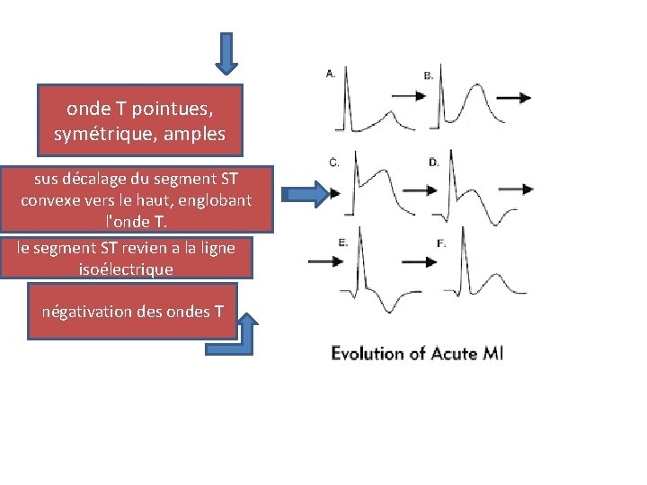 onde T pointues, symétrique, amples sus décalage du segment ST convexe vers le haut,