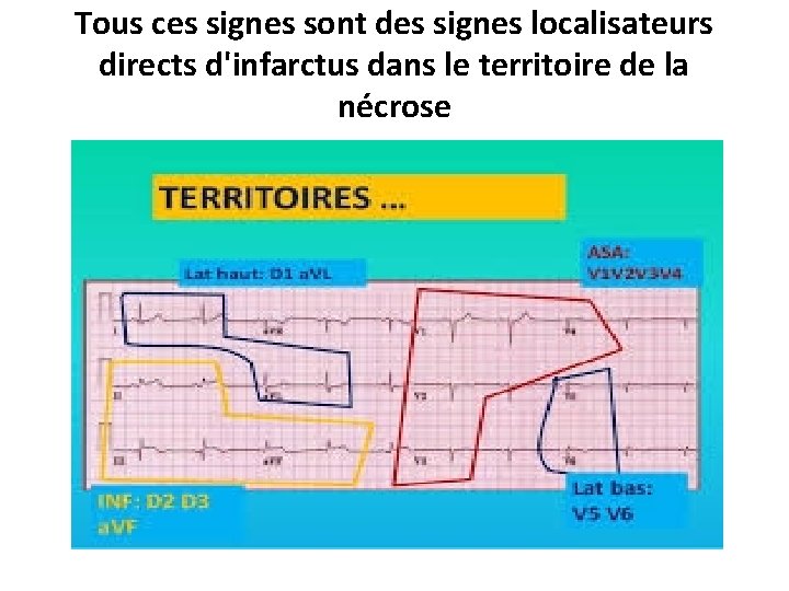 Tous ces signes sont des signes localisateurs directs d'infarctus dans le territoire de la