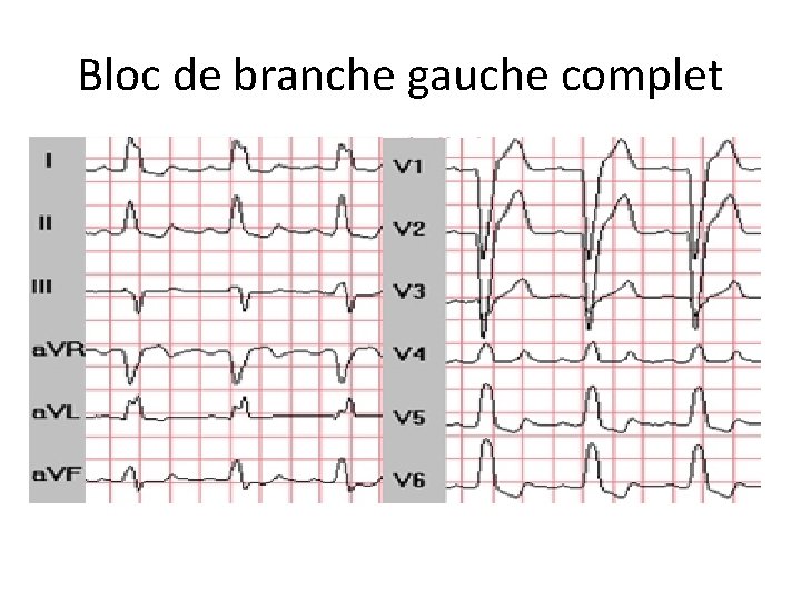 Bloc de branche gauche complet 