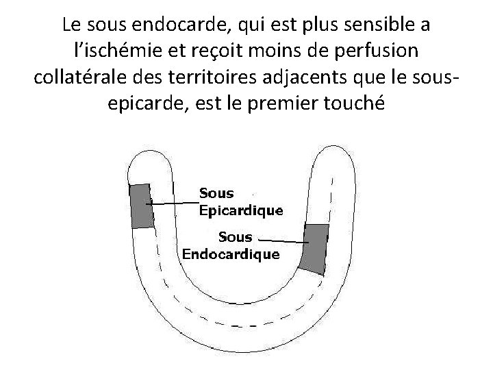 Le sous endocarde, qui est plus sensible a l’ischémie et reçoit moins de perfusion