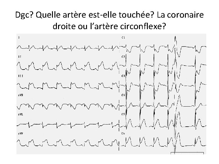 Dgc? Quelle artère est-elle touchée? La coronaire droite ou l’artère circonflexe? 