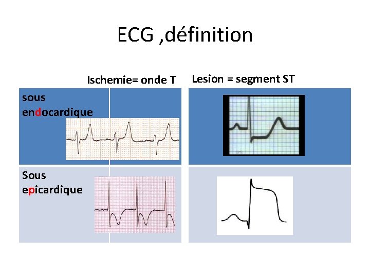 ECG , définition Ischemie= onde T sous endocardique Sous epicardique Lesion = segment ST