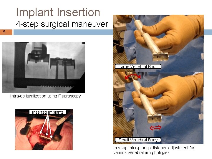 Implant Insertion 4 -step surgical maneuver 5 Large Vertebral Body Intra-op localization using Fluoroscopy