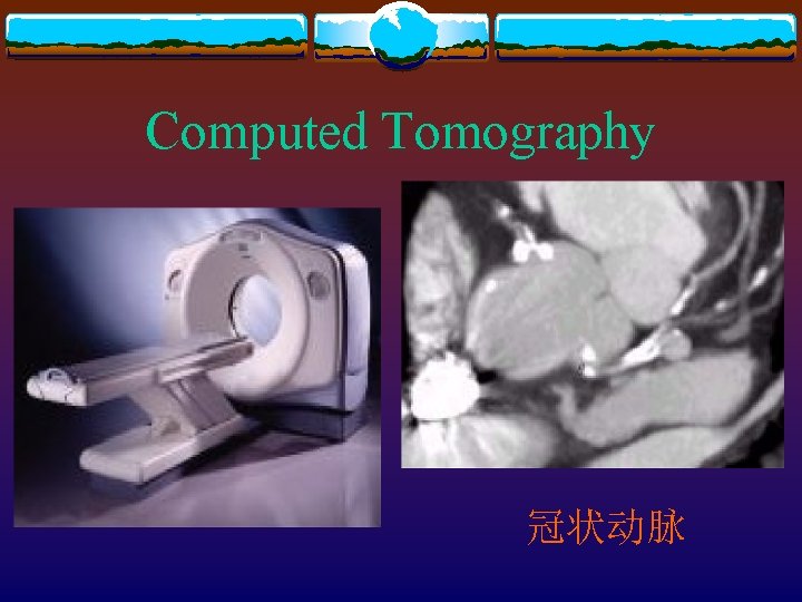 Computed Tomography 冠状动脉 