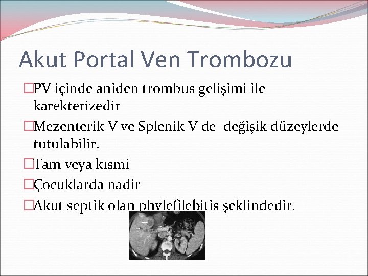 Akut Portal Ven Trombozu �PV içinde aniden trombus gelişimi ile karekterizedir �Mezenterik V ve