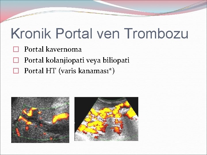 Kronik Portal ven Trombozu � Portal kavernoma � Portal kolanjiopati veya biliopati � Portal