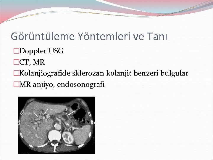 Görüntüleme Yöntemleri ve Tanı �Doppler USG �CT, MR �Kolanjiografide sklerozan kolanjit benzeri bulgular �MR