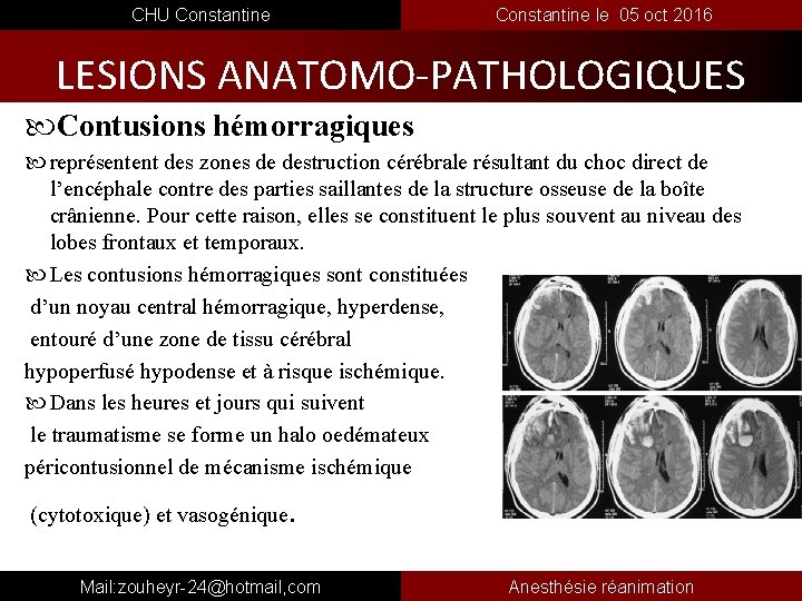  CHU Constantine le 05 oct 2016 LESIONS ANATOMO-PATHOLOGIQUES Contusions hémorragiques représentent des zones