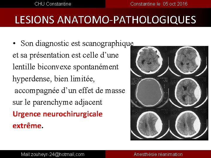  CHU Constantine le 05 oct 2016 LESIONS ANATOMO-PATHOLOGIQUES • Son diagnostic est scanographique