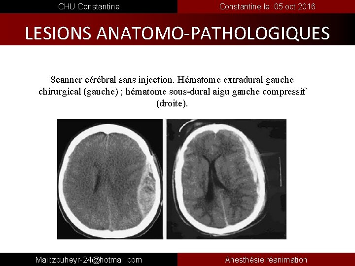  CHU Constantine le 05 oct 2016 LESIONS ANATOMO-PATHOLOGIQUES Scanner cérébral sans injection. Hématome