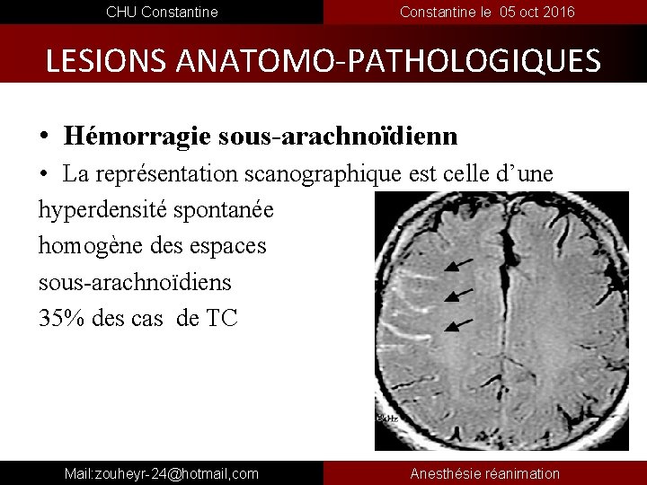  CHU Constantine le 05 oct 2016 LESIONS ANATOMO-PATHOLOGIQUES • Hémorragie sous-arachnoïdienn • La