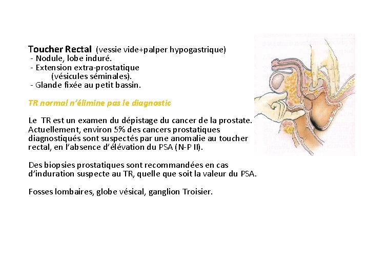 Toucher Rectal (vessie vide+palper hypogastrique) - Nodule, lobe induré. - Extension extra-prostatique (vésicules séminales).