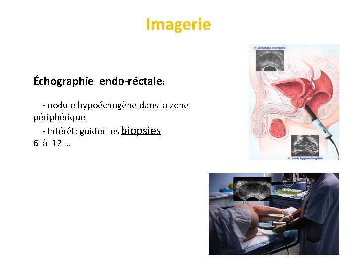 Imagerie Échographie endo-réctale: - nodule hypoéchogène dans la zone périphérique - Intérêt: guider les