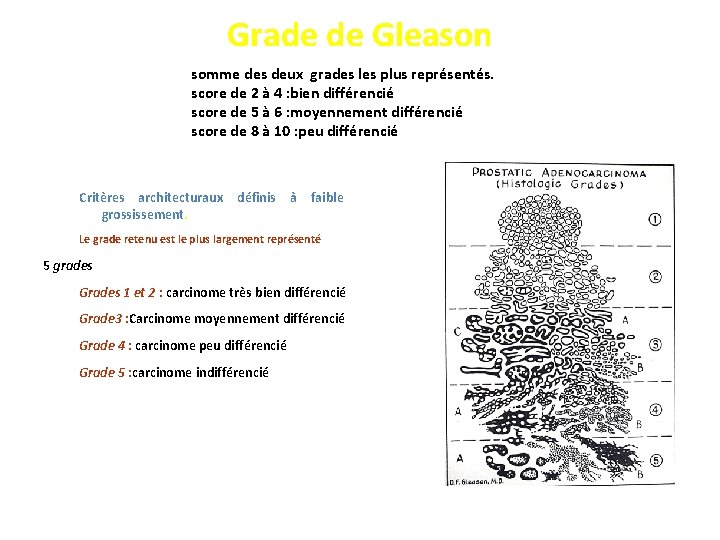 Grade de Gleason somme des deux grades les plus représentés. score de 2 à