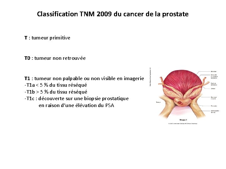Classification TNM 2009 du cancer de la prostate T : tumeur primitive T 0