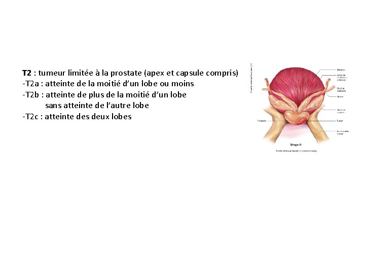 T 2 : tumeur limitée à la prostate (apex et capsule compris) -T 2