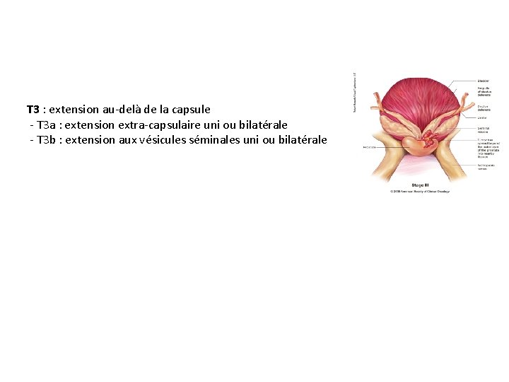 T 3 : extension au-delà de la capsule - T 3 a : extension