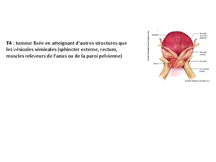T 4 : tumeur fixée en atteignant d’autres structures que les vésicules séminales (sphincter