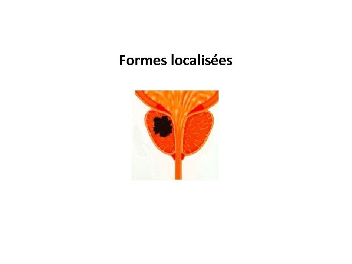 Formes localisées 