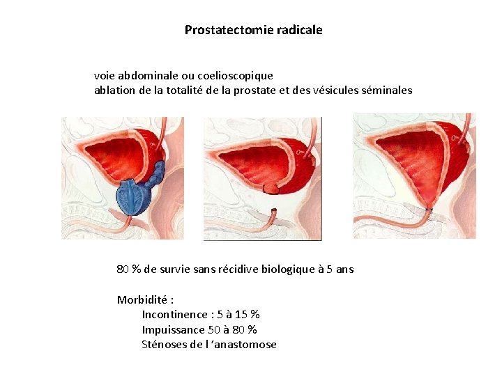 Prostatectomie radicale voie abdominale ou coelioscopique ablation de la totalité de la prostate et