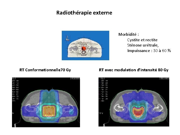 Radiothérapie externe Morbidité : Cystite et rectite Sténose urétrale, Impuissance : 30 à 60