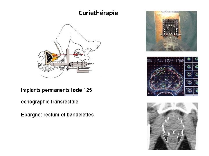 Curiethérapie Implants permanents Iode 125 échographie transrectale Epargne: rectum et bandelettes 