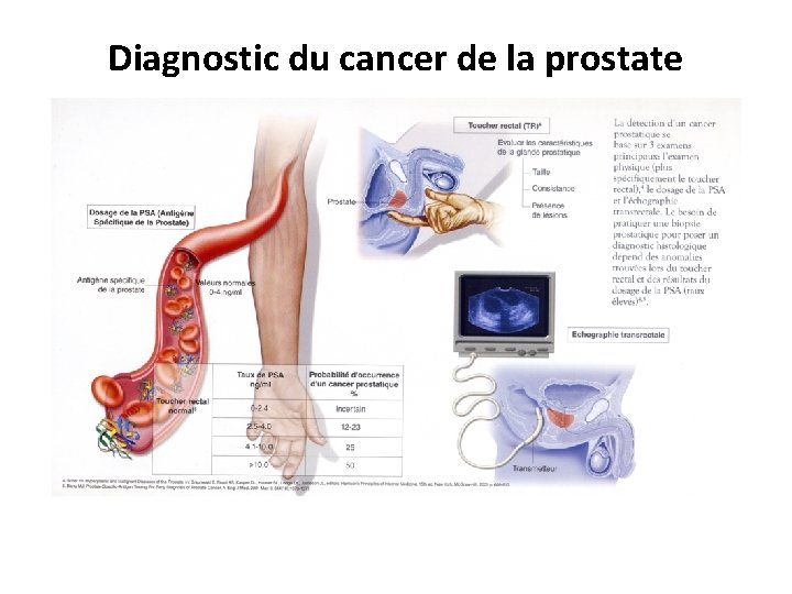 Diagnostic du cancer de la prostate 