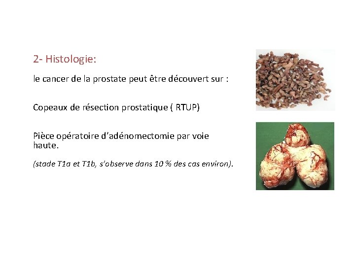 2 - Histologie: le cancer de la prostate peut être découvert sur : Copeaux