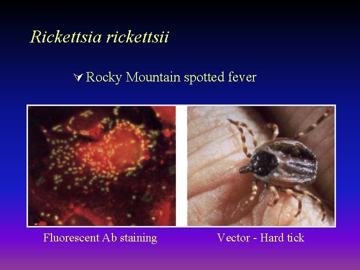 Rickettsia rickettsii Ú Rocky Mountain spotted fever Fluorescent Ab staining Vector - Hard tick