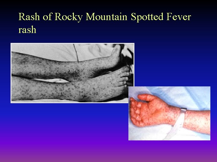 Rash of Rocky Mountain Spotted Fever rash 