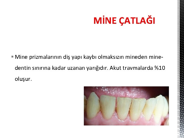 MİNE ÇATLAĞI § Mine prizmalarının diş yapı kaybı olmaksızın minedentin sınırına kadar uzanan yarığıdır.