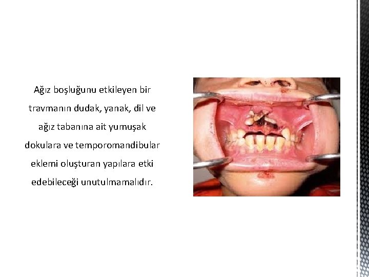 Ağız boşluğunu etkileyen bir travmanın dudak, yanak, dil ve ağız tabanına ait yumuşak dokulara