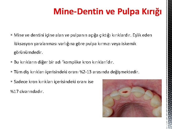 Mine-Dentin ve Pulpa Kırığı § Mine ve dentini içine alan ve pulpanın açığa çıktığı