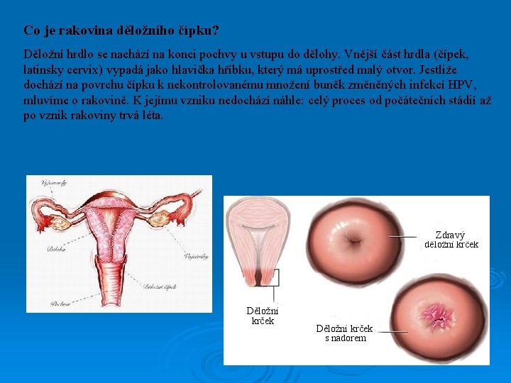 Co je rakovina děložního čípku? Děložní hrdlo se nachází na konci pochvy u vstupu