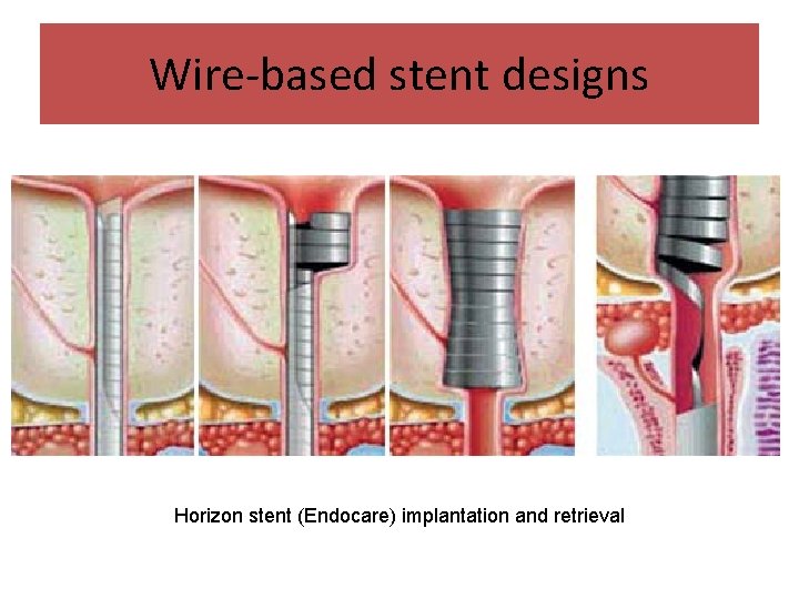 Wire-based stent designs Horizon stent (Endocare) implantation and retrieval 