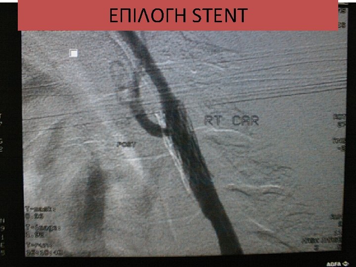 ΕΠΙΛΟΓΗ STENT Carotid angioplasty and stenting 