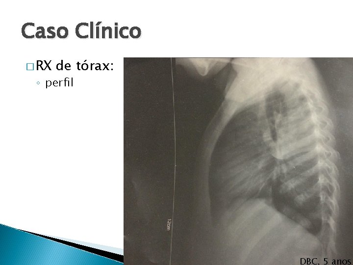 Caso Clínico � RX de tórax: ◦ perfil DBC, 5 anos 