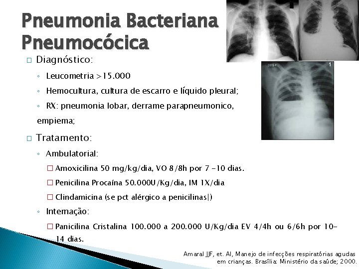 Pneumonia Bacteriana Pneumocócica � Diagnóstico: ◦ Leucometria >15. 000 ◦ Hemocultura, cultura de escarro